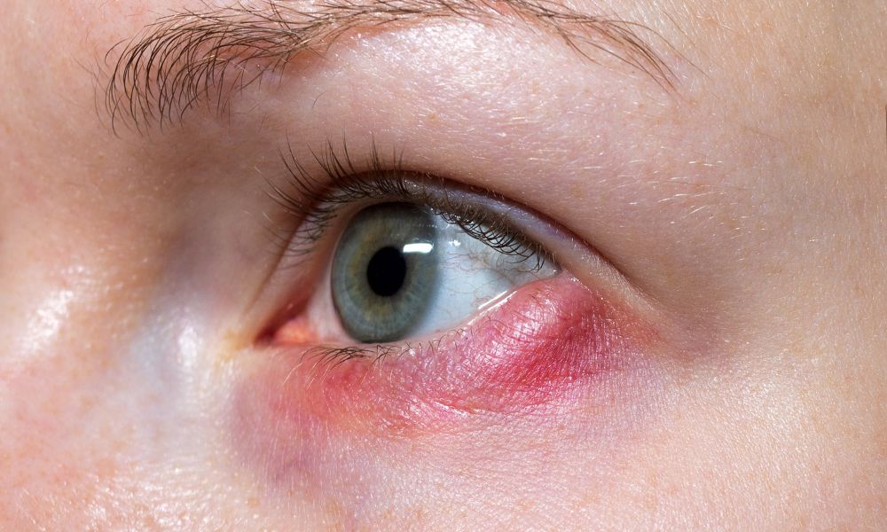 Ako vzniká jačmeň na oku a prečo sa stále vracia